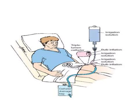Bladder irrigation | PPTX