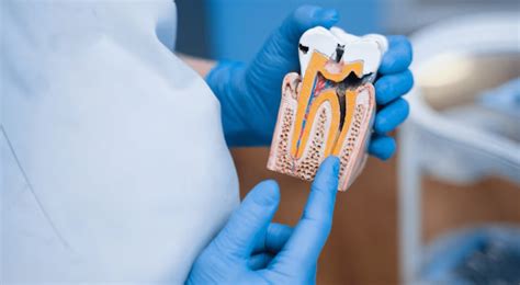 Root Canal Aftercare: 5 Effective Tips for Speedy Recovery
