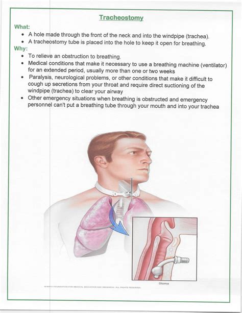 Image result for Trach Procedure