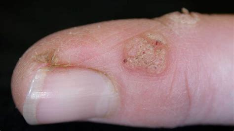 Skin Lesions: Pictures, Causes, Types, Risks, Diagnosis, and Treatments