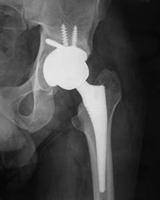 Hip Replacement: Acetabular fracture surgery Chennai | Ceramic hip ...