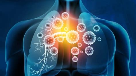 Understanding viral pneumonia symptoms and causes today