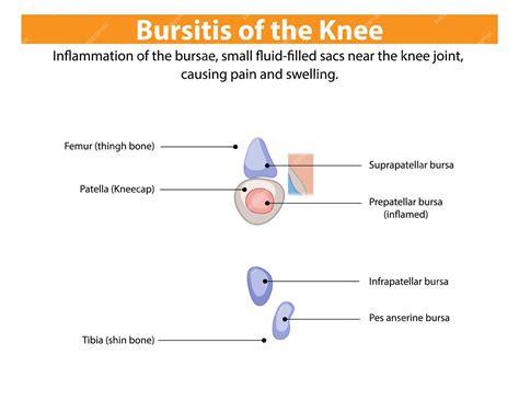 Free Vector | Bursitis of the Knee Illustration
