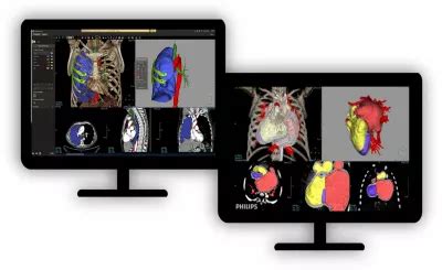 Philips - Multi Modality Advanced Vessel Analysis (AVA)