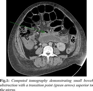 Small Bowel Obstruction Caused By Retained Placenta Post Emergency ...
