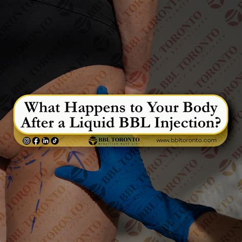 What Happens to Your Body After a Liquid BBL Injection? - Liquid BBL Toronto | Non-Surgical BBL ...