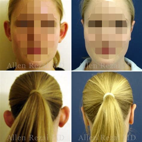 Image result for Ear Modification