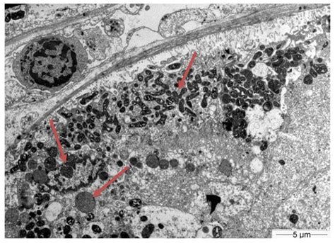 Tenofovir-Induced Fanconi Syndrome Presenting with Life-Threatening ...