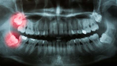 Extracted Wisdom Tooth 的图像结果