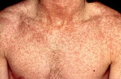 Bildergebnis für rubella symptoms