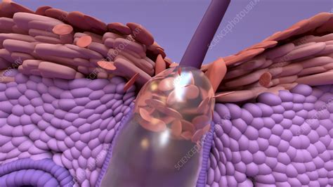 Image result for Sebum Plug Extraction