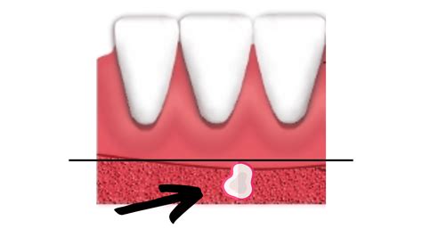 Gum Ulcer: Every Potential Cause Explained