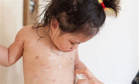 Why is chickenpox called chickenpox? The infection's name explained and ...
