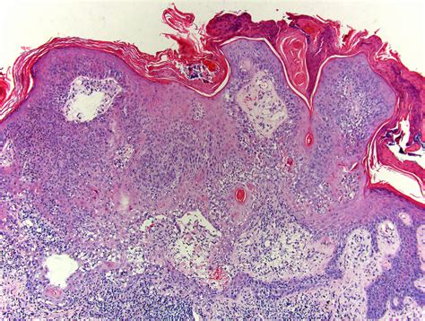 Inflamed Seborrheic Keratosis