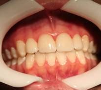 Image result for Discolored Tooth