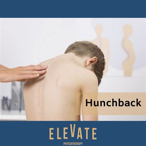 Physiotherapy for Upper Back Pain, Singapore | Hunchback