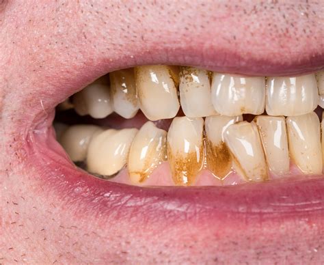 Does Zinc Stain Teeth