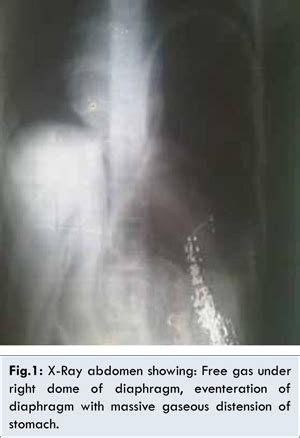 Strangulated Gastric Volvulus