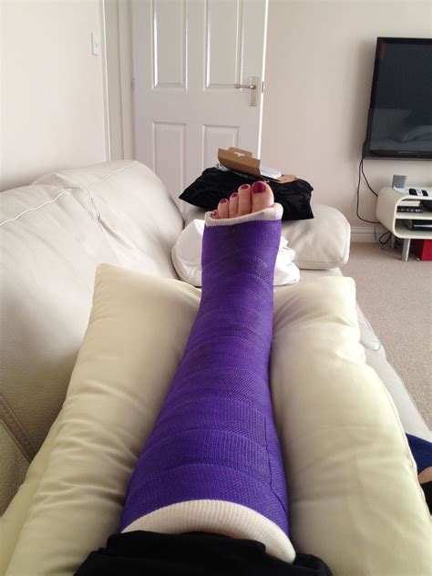 Broken Foot Cast
