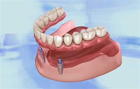 Image result for Immediate Denture Process