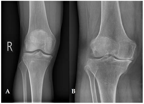 Articular Cartilage: Structure, Biomechanics, and the Potential of Conventional and Advanced ...