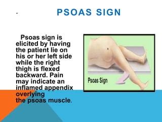 Image result for Psoas Sign Appendicitis