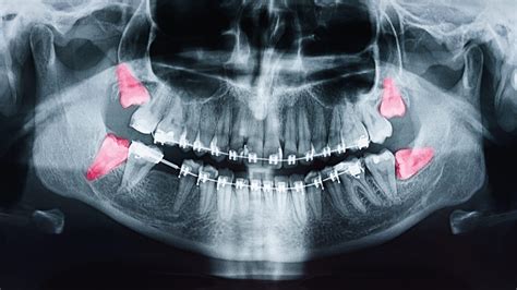 Wisdom Teeth Leeds | Wisdom Tooth Removal - The Tooth Spa Leeds