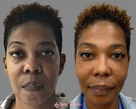 Under Eye Fillers - Before & After Results at Skinly