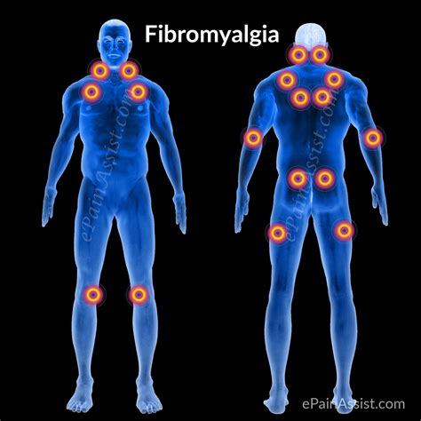 FAQ on Fibromyalgia|Symptoms|11 Painful Trigger Points|Causes|Risk Factors