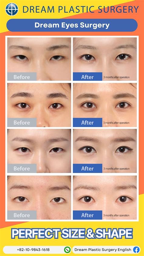 Double eyelid surgery before and after at dream plastic surgery clinic ...
