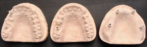 Image result for How to Take Study Models with Plaster Lab