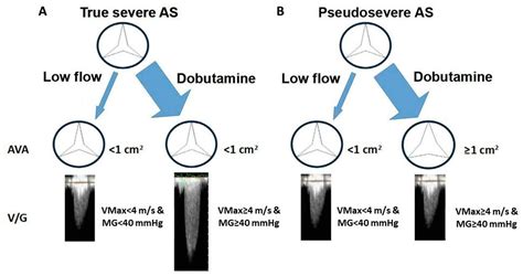 Diagnostic Challenges in Aortic Stenosis