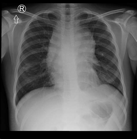 Hospital X-ray Chest 的图像结果