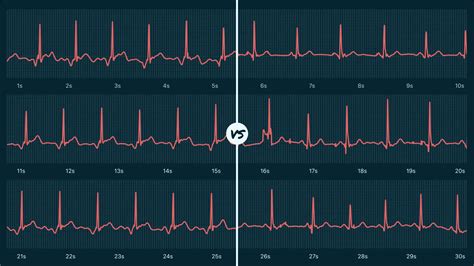 Junctional Rhythm Vs. Sinus Rhythm on Your Watch ECG | Qaly