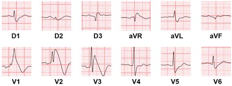 Uncommon and Accessory Electrocardiographic Findings in Brugada Syndrome: A Review