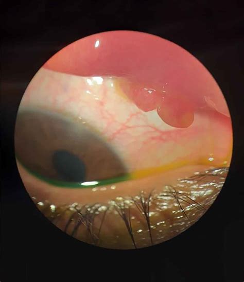 Pyogenic Granuloma Eye Treatment