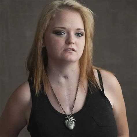 Heart Transplant Surgery Scar