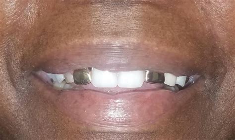 Image result for How to Clean Front Teeth Partials