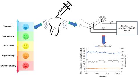 Electrodermal Activity for Quantitative Assessment of Dental Anxiety