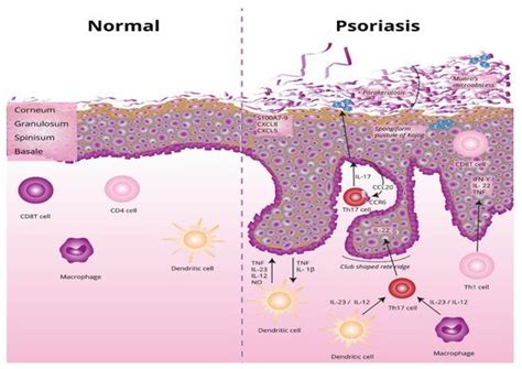 Etiopathogenesis of Psoriasis | Encyclopedia MDPI