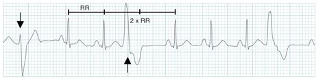 Image result for PVC ECG Reading