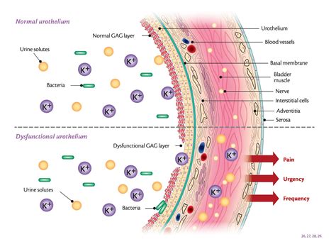 Painful Bladder Syndrome - Interstitial Cystitis (PBS/IC) - Brisbane Obstetrician ...