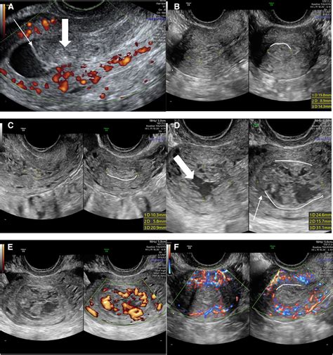 The accuracy of ultrasound scan in diagnosing retained products of ...