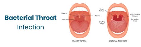 Throat Infection: Symptoms, Causes & Treatments