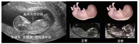 怀孕12周NT图片，不知道是否能看得出来男孩女孩前期怀孕6周胎囊是17*16*1 - 百度宝宝知道