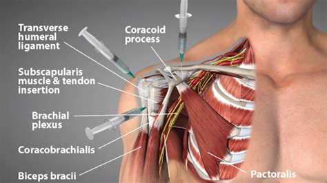 Image result for Shoulder Injection Fluoroscopy