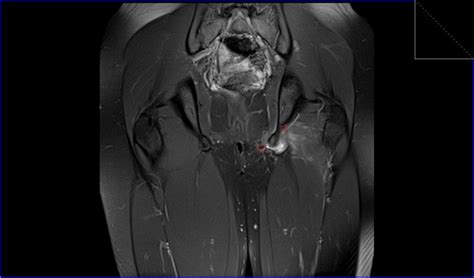 Hamstring Injury MRI | Radiology article on Hamstring Injury