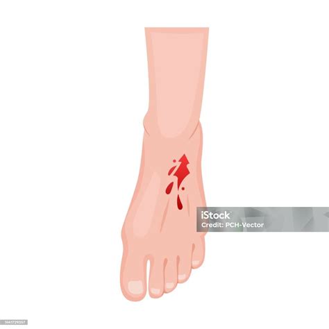 Open Laceration On Top Of Foot Traumas Of Skin On Body Part Vector Illustration Of Open Cut ...