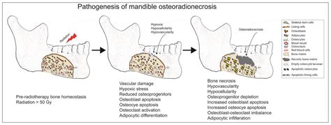 Diagnostic and Therapeutic Approaches to Jaw Osteoradionecrosis