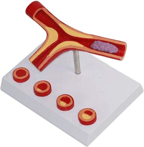 CEEBUS Arteriosclerosis Cardiovascular Model for Teaching India | Ubuy